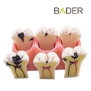 MODELO DEMOSTRACIÓN DESMONTABLE CON CARIES