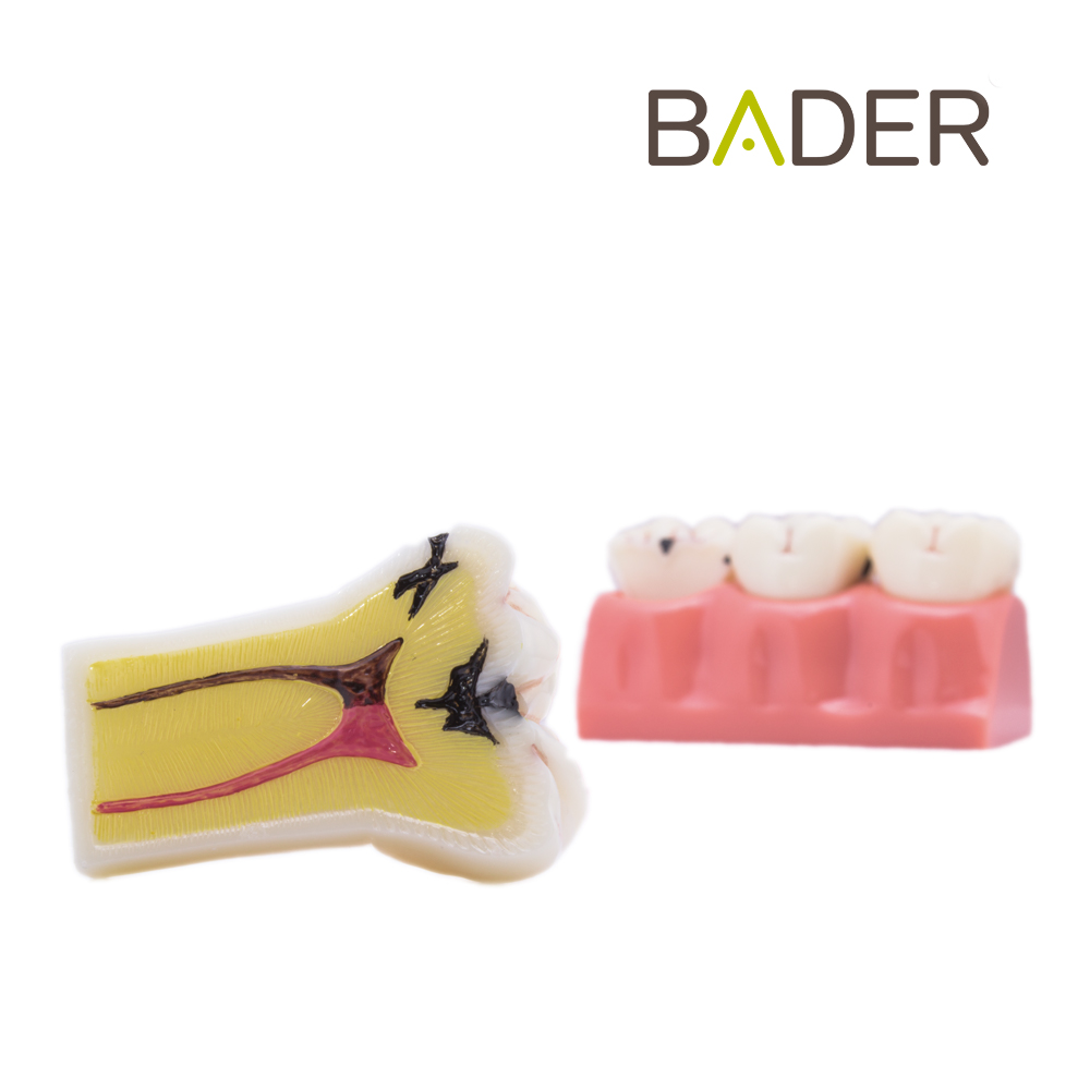 MODELO DEMOSTRACIÓN DESMONTABLE CON CARIES