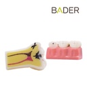 MODELO DEMOSTRACIÓN DESMONTABLE CON CARIES