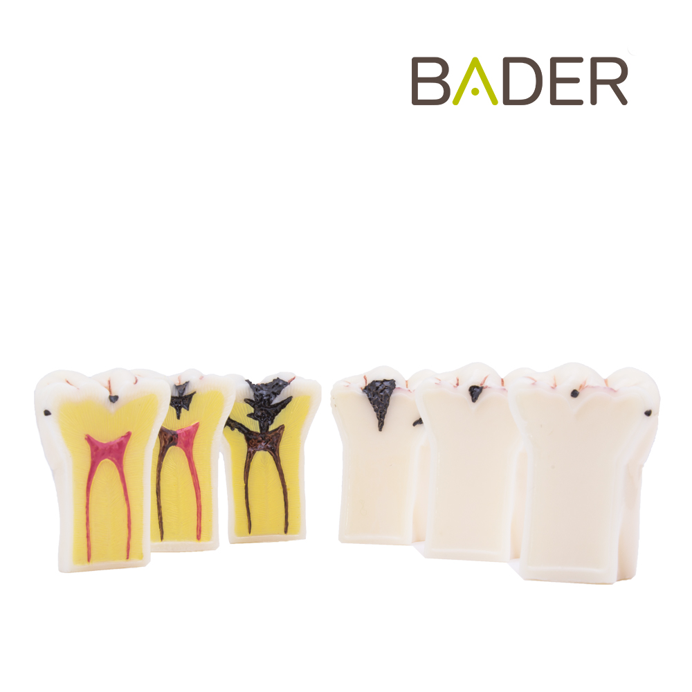MODELO DEMOSTRACIÓN DESMONTABLE CON CARIES