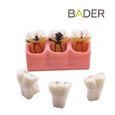 MODELO DEMOSTRACIÓN DESMONTABLE CON CARIES