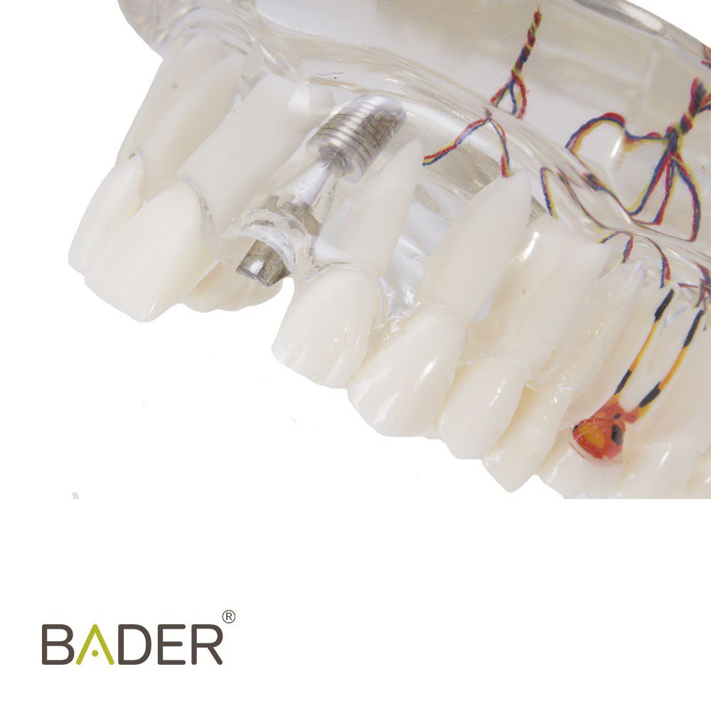 MODELO DENTAL DE IMPLANTE CON NERVIO