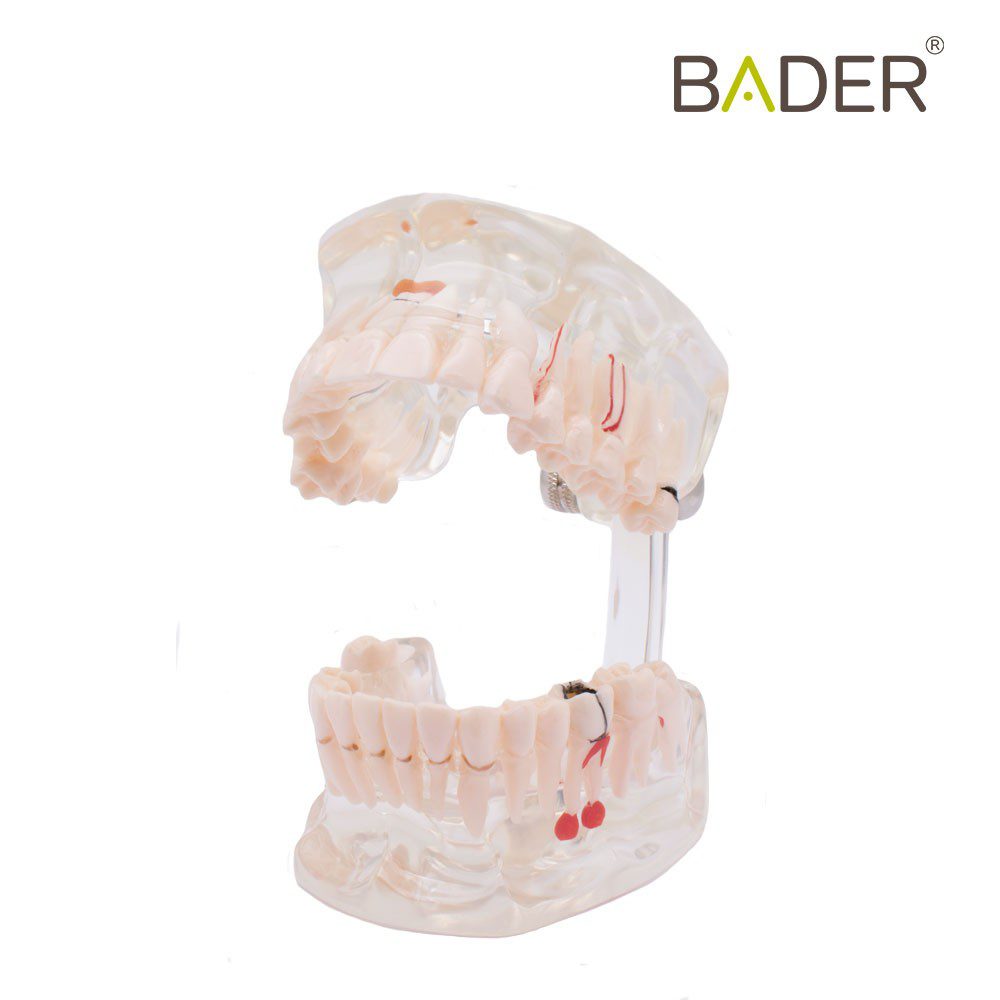 MODELO DENTAL TRANSPARENTE IMPLANTE