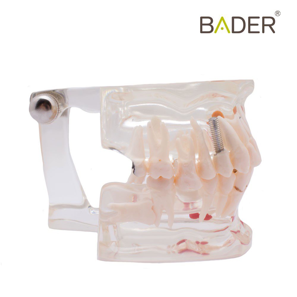 MODELO DENTAL TRANSPARENTE IMPLANTE