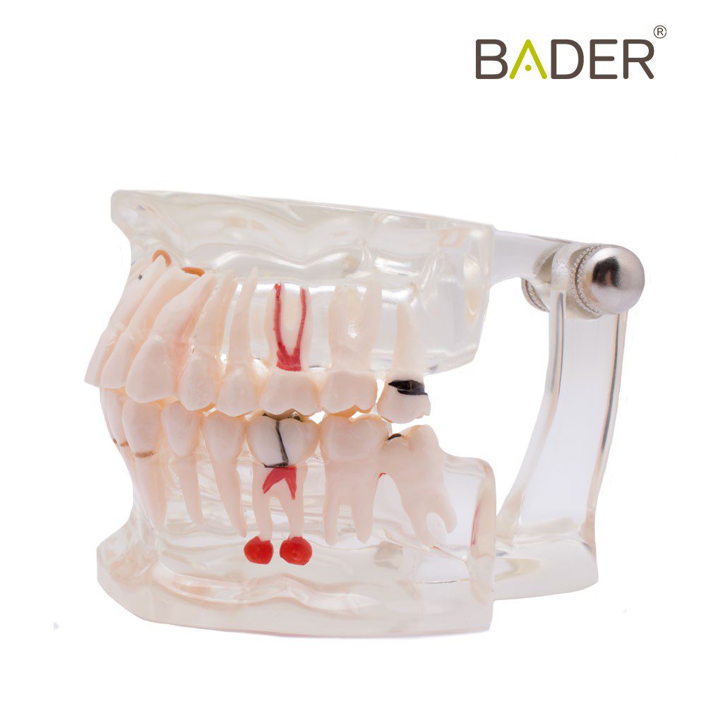 MODELO DENTAL TRANSPARENTE IMPLANTE