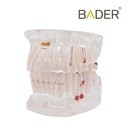 MODELO DENTAL TRANSPARENTE IMPLANTE