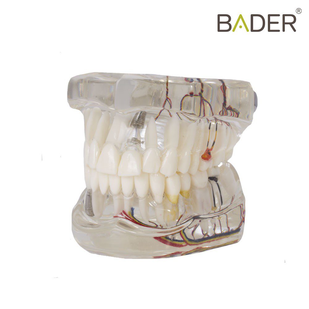 MODELO DENTAL TRANSPARENTE DE IMPLANTE CON NERVIO