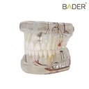 MODELO DENTAL TRANSPARENTE DE IMPLANTE CON NERVIO