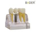 MODELO DE DEMOSTRACIÓN DE IMPLANTES