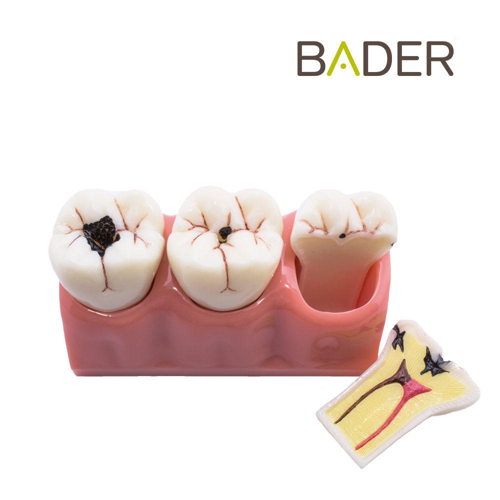 MODELO DEMOSTRACIÓN DESMONTABLE CON CARIES