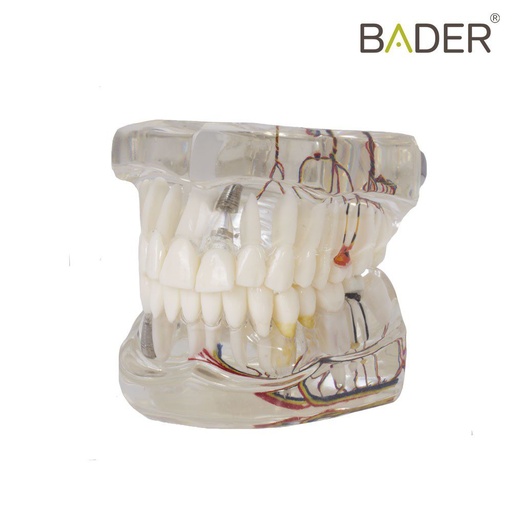 [0905111] MODELO DENTAL TRANSPARENTE DE IMPLANTE CON NERVIO