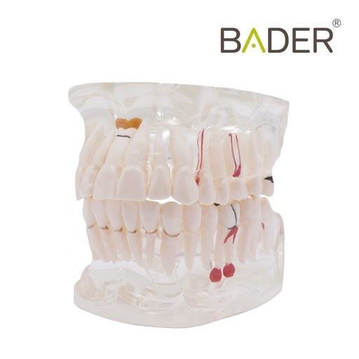 [0905114] MODELO DENTAL TRANSPARENTE CARIES