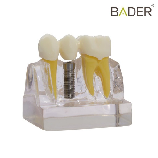 [0905108] MODELO DE DEMOSTRACIÓN DE IMPLANTES